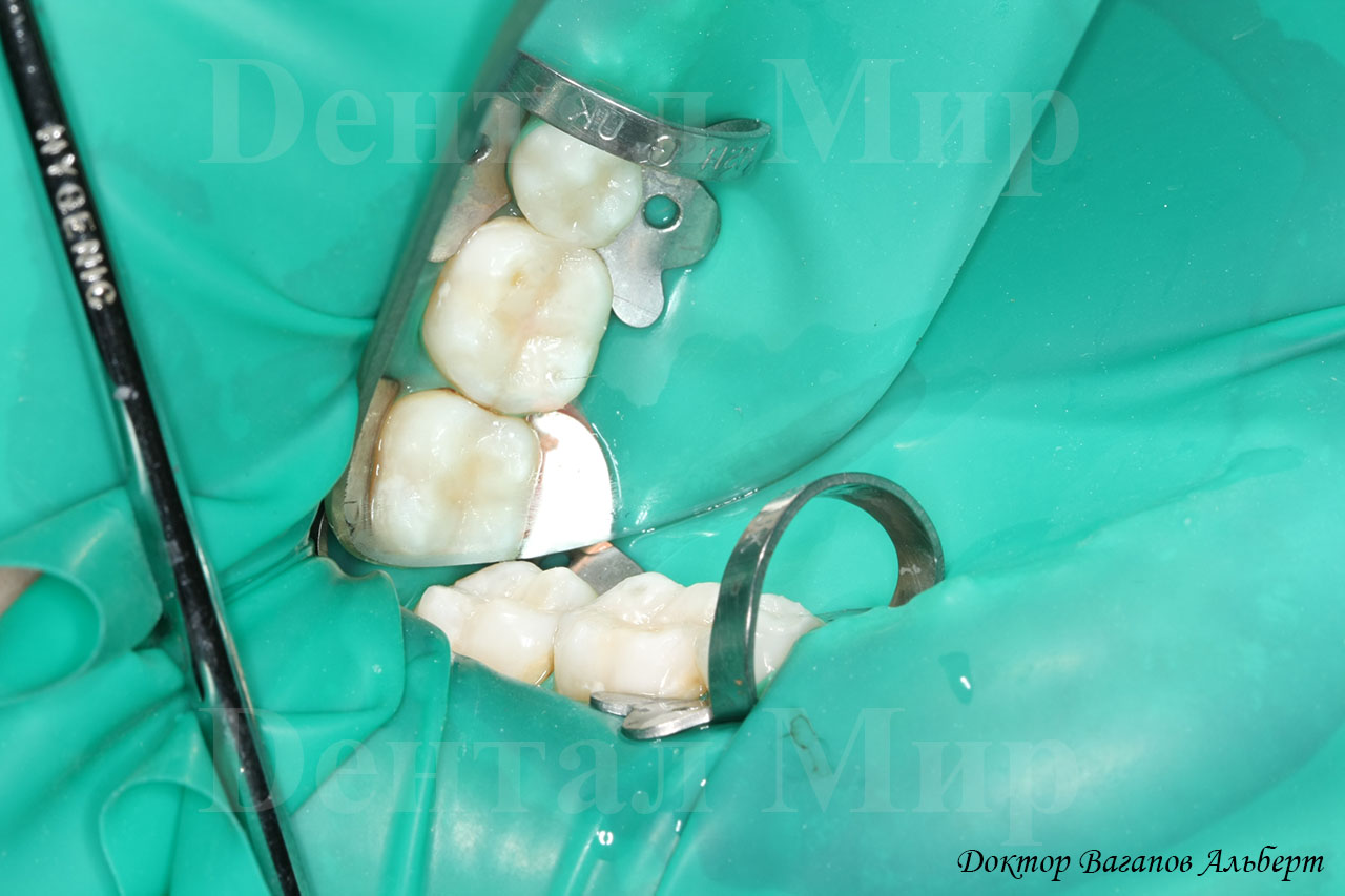 Фотография поверхности жевательных поверхностей зубов после постановки пломбы