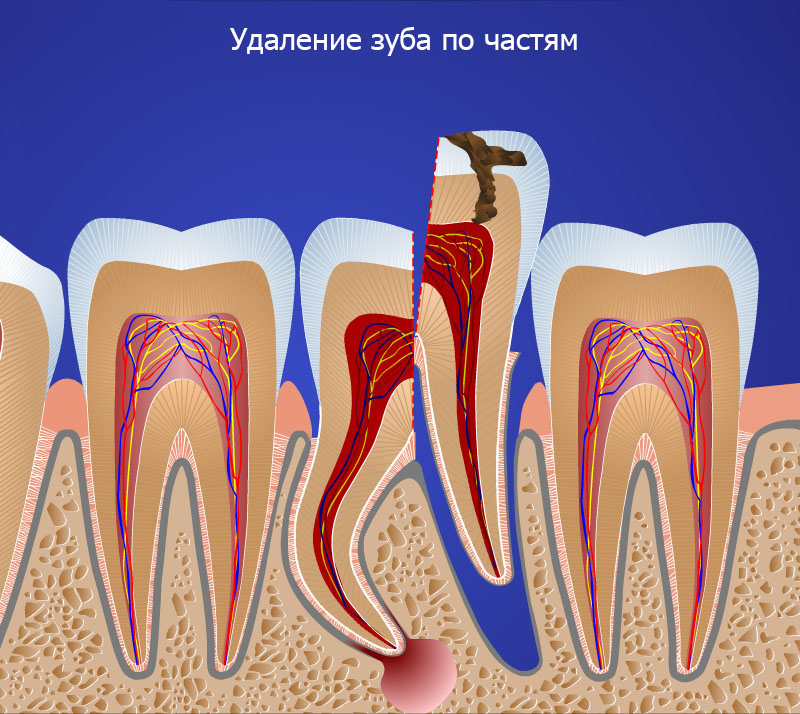 Извлечение зуба по частям