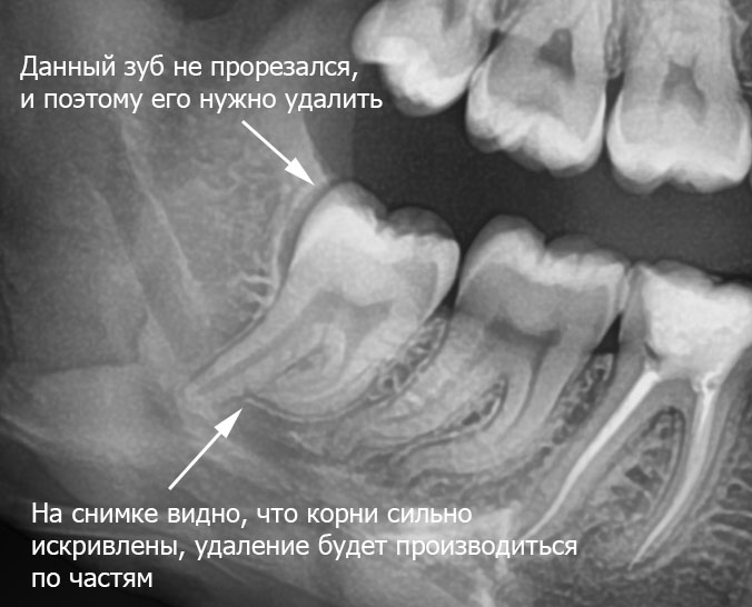 Искривленные корни зуба.