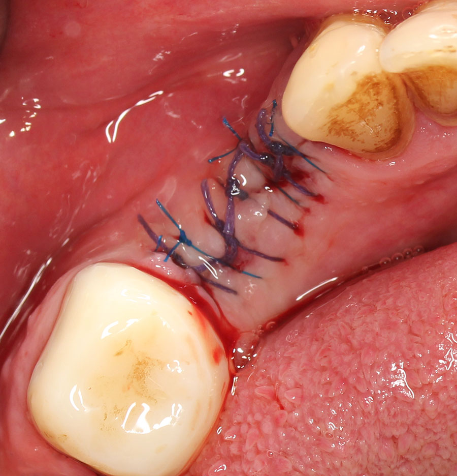 Хруст в челюсти после удаления зуба