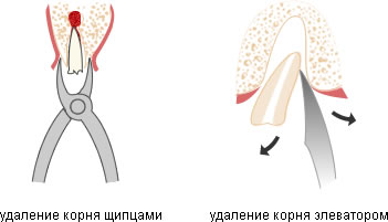 Удаление корней зубов